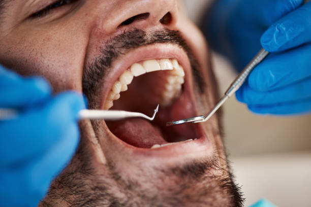 Best Wisdom Tooth Removal  in Dunkirk, MD